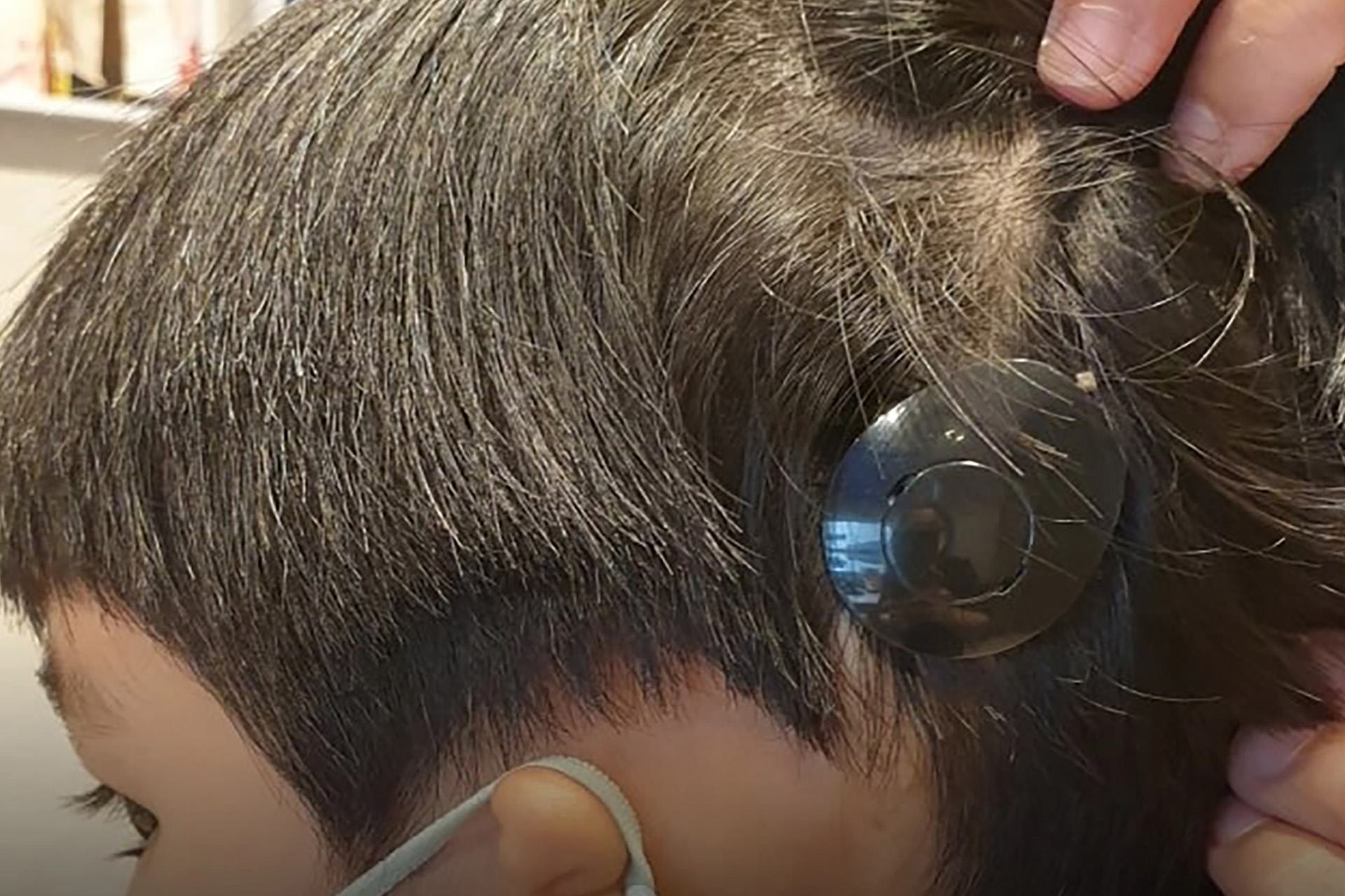 bone conduction implant audiologist